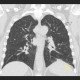Welder's lung, pulmonary siderosis: CT - Computed tomography