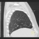 Welder's lung, pulmonary siderosis: CT - Computed tomography
