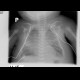 Neonatal lung, respiratory distress: X-ray - Plain radiograph