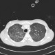 Pneumococcal pneumonia, initial: CT - Computed tomography