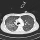 Pneumococcal pneumonia, initial: CT - Computed tomography