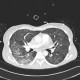 Pneumococcal pneumonia, initial: CT - Computed tomography