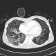 Pneumococcal pneumonia, initial: CT - Computed tomography