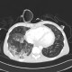 Pneumococcal pneumonia, initial: CT - Computed tomography