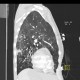 Pneumococcal pneumonia, initial: CT - Computed tomography