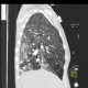 Pneumococcal pneumonia, initial: CT - Computed tomography