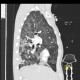 Pneumococcal pneumonia, initial: CT - Computed tomography