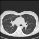 Pneumococcal pneumonia, resolution: CT - Computed tomography