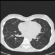 Pneumococcal pneumonia, resolution: CT - Computed tomography