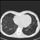 Pneumococcal pneumonia, resolution: CT - Computed tomography