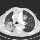 Pneumonia, centrilobular emphysema: CT - Computed tomography