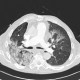 Pneumonia, centrilobular emphysema: CT - Computed tomography