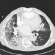 Pneumonia, centrilobular emphysema: CT - Computed tomography