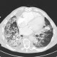 Pneumonia, centrilobular emphysema: CT - Computed tomography