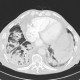 Pneumonia, centrilobular emphysema: CT - Computed tomography