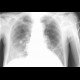 Skin fold mimicking pneumothorax: X-ray - Plain radiograph