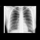 Pneumothorax: X-ray - Plain radiograph