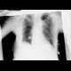 Pneumothorax, complication of central venous line: X-ray - Plain radiograph