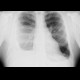 Pneumothorax after evacuation of pleural fluid: X-ray - Plain radiograph