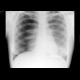 Tension pneumothorax: X-ray - Plain radiograph