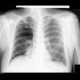 Pneumotorax: X-ray - Plain radiograph