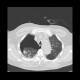 Pneumothorax: CT - Computed tomography