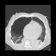 Pneumothorax: CT - Computed tomography