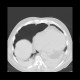 Pneumothorax: CT - Computed tomography