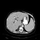 Polycystosis of kidney, adult polycystic kidney disease, ADPKD, liver cysts, Tenckhoff catheter, peritoneal dialysis: CT - Computed tomography