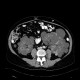 Polycystosis of kidney, adult polycystic kidney disease, ADPKD, liver cysts, Tenckhoff catheter, peritoneal dialysis: CT - Computed tomography