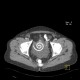 Polycystosis of kidney, adult polycystic kidney disease, ADPKD, liver cysts, Tenckhoff catheter, peritoneal dialysis: CT - Computed tomography