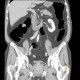 Polyp of hepatic flexure, CT colonography: CT - Computed tomography