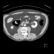 Polyp of hepatic flexure, CT colonography: CT - Computed tomography