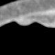 Polyp of sigmoid colon, dimitutive polyp, sessile polyp, CT colonography: CT - Computed tomography