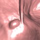 Polyp of sigmoid colon, dimitutive polyp, sessile polyp, CT colonography, VE: CT - Computed tomography