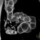 Polyp of sigmoid colon, dimitutive polyp, sessile polyp, CT colonography, VRT: CT - Computed tomography