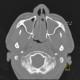 Polyposis of nose and paranasal sinuses: CT - Computed tomography