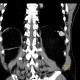 Polysplenia, splenunculi: CT - Computed tomography