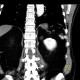 Polysplenia, splenunculi: CT - Computed tomography