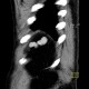 Polysplenia, splenunculi: CT - Computed tomography