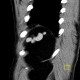 Polysplenia, splenunculi: CT - Computed tomography