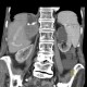 Porto-venous shunt of the liver: CT - Computed tomography