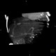 Porto-venous shunt of the liver: CT - Computed tomography