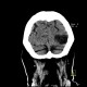 Postmalatic pseudocyst: CT - Computed tomography