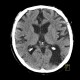 Postmalatic pseudocyst: CT - Computed tomography