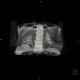 Postpyelonephritic changes, nephrolithiasis, kidney stones, VRT: CT - Computed tomography