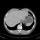 Posttraumatic splenic pseudocyst: CT - Computed tomography