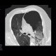 Bullous emphysema, pneumothorax: CT - Computed tomography