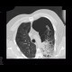 Bullous emphysema, pneumothorax: CT - Computed tomography
