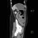 Ulcerative colitis, enterography: CT - Computed tomography